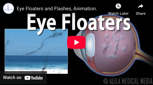 What Causes Eye Floaters?